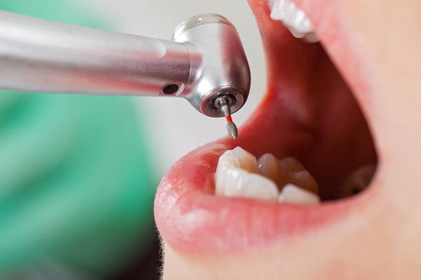 Best Knocked-Out Tooth (Avulsed Tooth) Treatment in Depoe Bay, OR